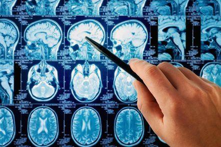 Good Brain, Bad Brain: Parkinson's Disease (FutureLearn)