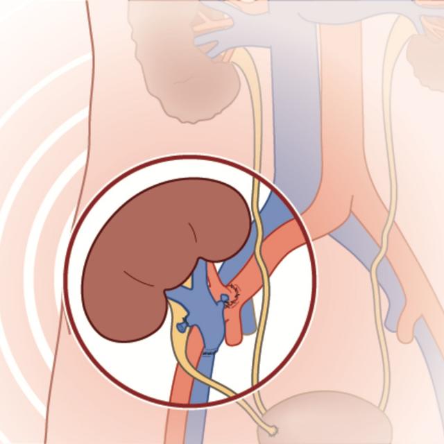 Clinical Kidney, Pancreas and Islet Transplantation (Coursera)