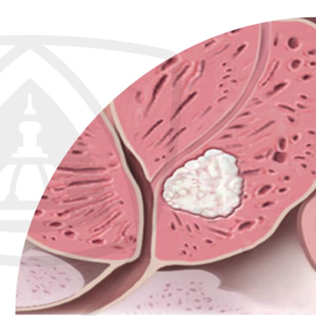 Understanding Prostate Cancer (Coursera)