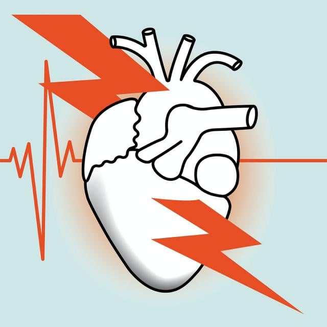 Myocardial Infarction (Coursera)