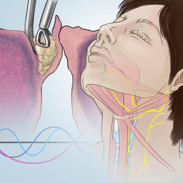 Voice Disorders: What Patients and Professionals Need to Know (Coursera)